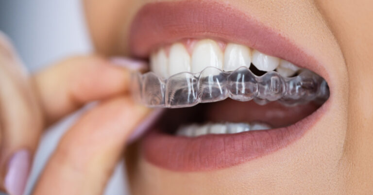 invisalign em itapevi